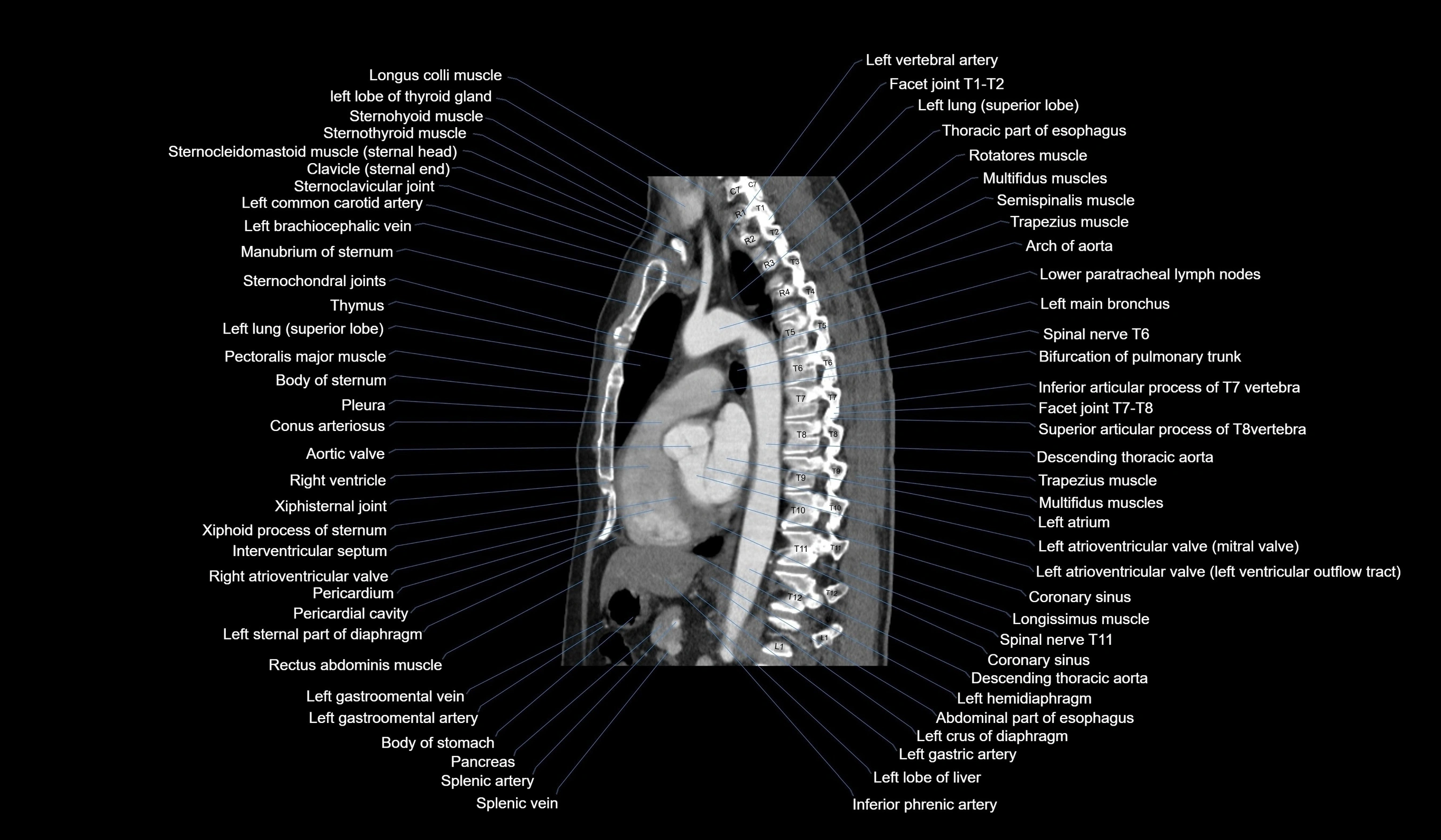 CT chest (thorax) soft tissue window labelled sagittal cross sectional anatomy radiology image-00079.webp